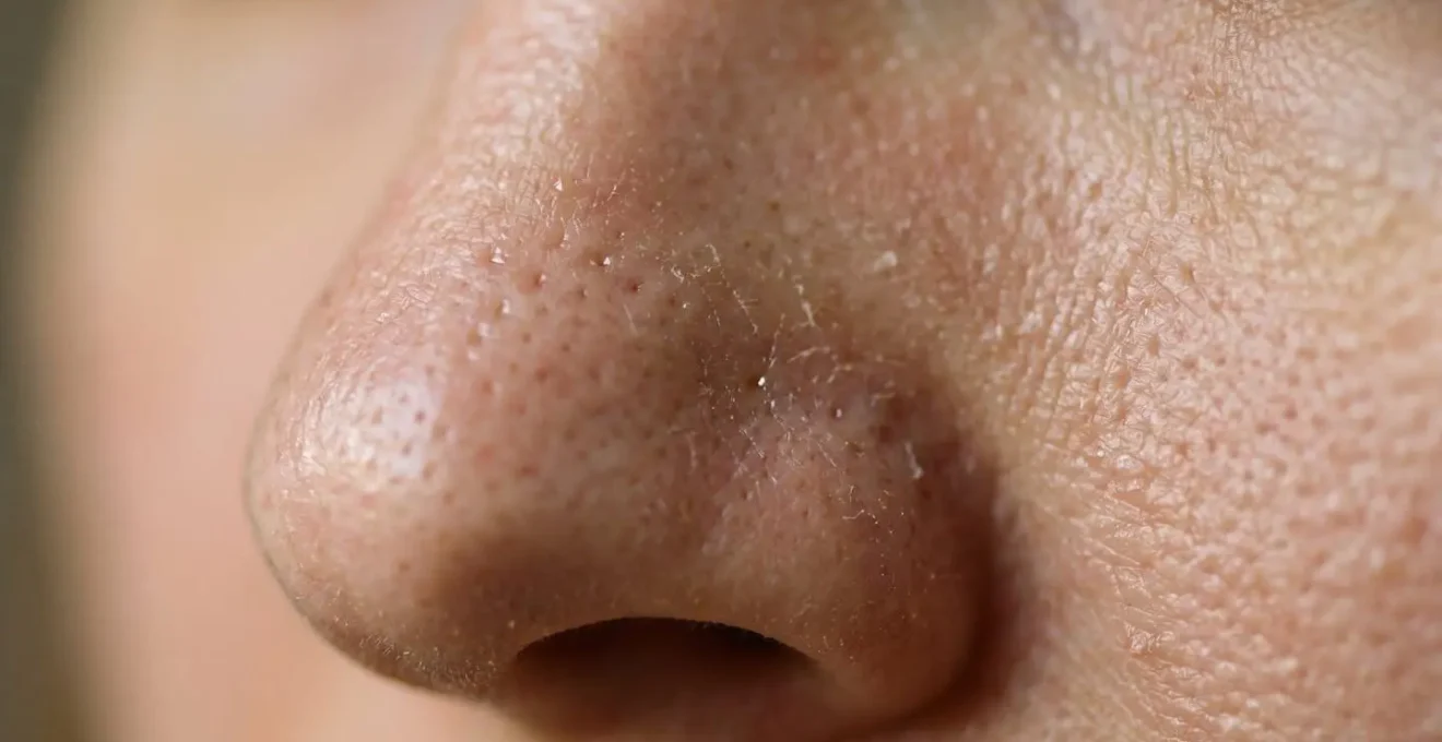 Fotografía macro de textura cutánea mostrando poros dilatados con falta de hidratación