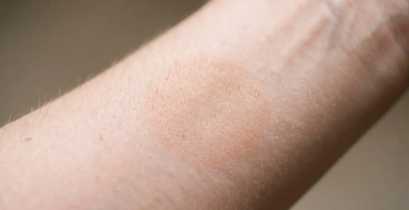 Detalle macro de un antebrazo mostrando la zona de aplicación del test de parche dermatológico